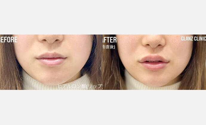 唇ヒアルロン酸