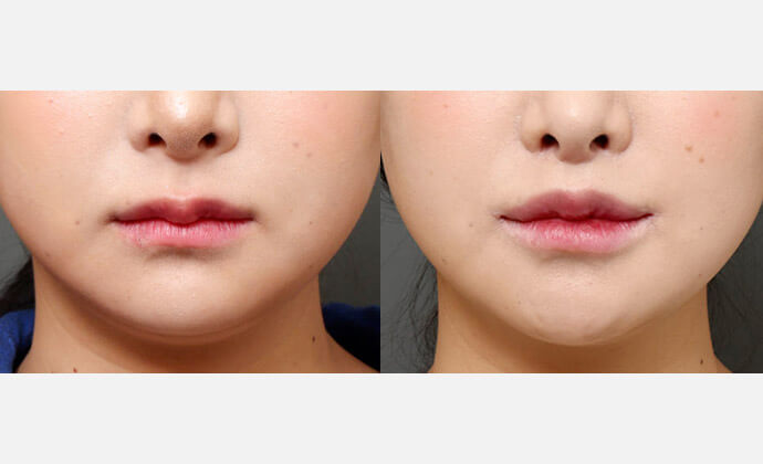 人中短縮手術（切開）