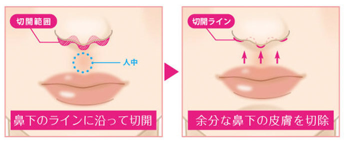 人中短縮手術（切開）の方法