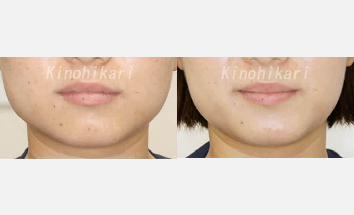 エラボトックスの症例