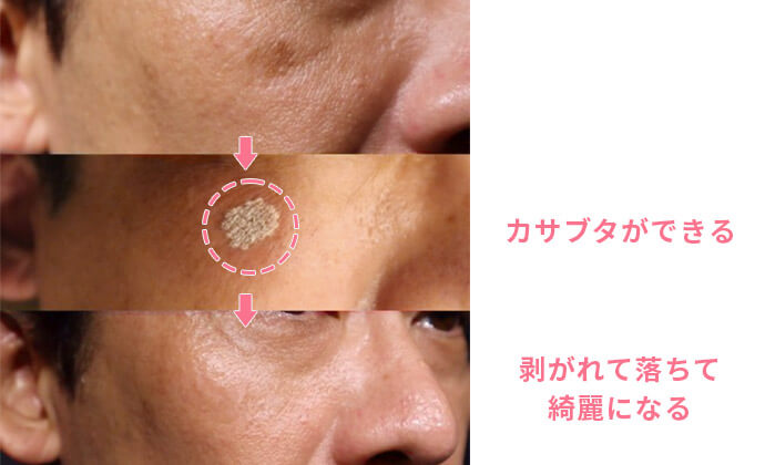 シミ取り治療の症例