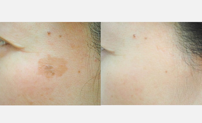 YAGレーザー＋高周波電気分解（左頬のしみ＋脂漏性角化症）の症例