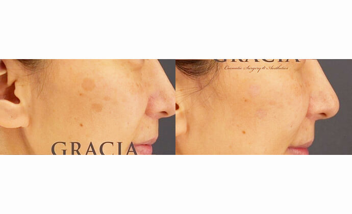 ピコスポットの症例