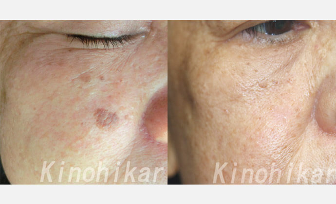 炭酸ガス（CO2）レーザーの症例