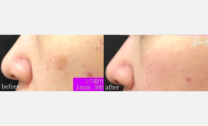 ピコレーザーの症例