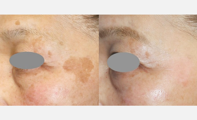 Qスイッチレーザーの症例