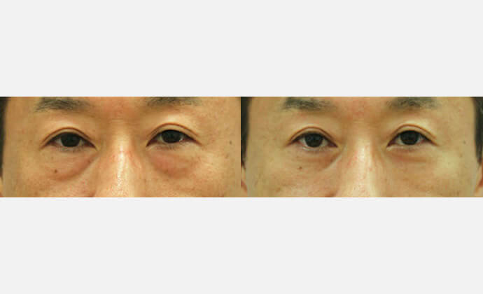 アイリフトの症例