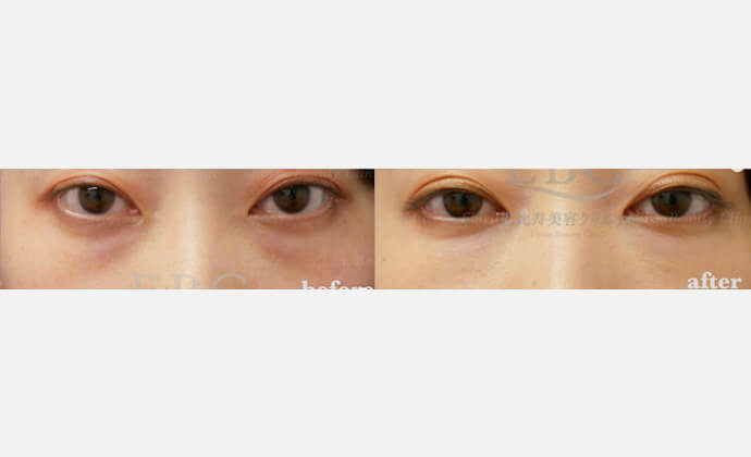 マドンナリフトの症例