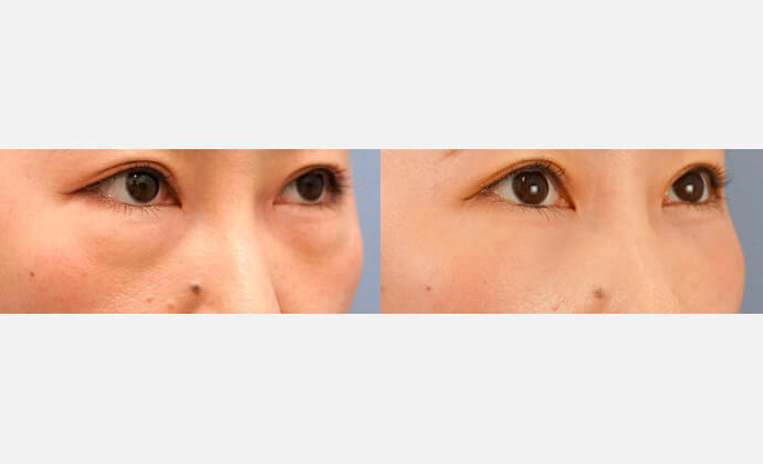 たるみクマ・膨らみの症例