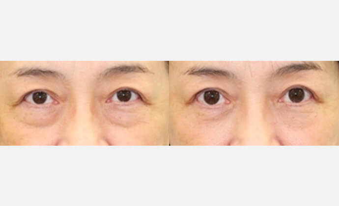 脱脂＋脂肪注入の症例