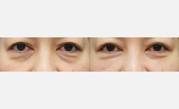 経結膜ハムラ法の症例