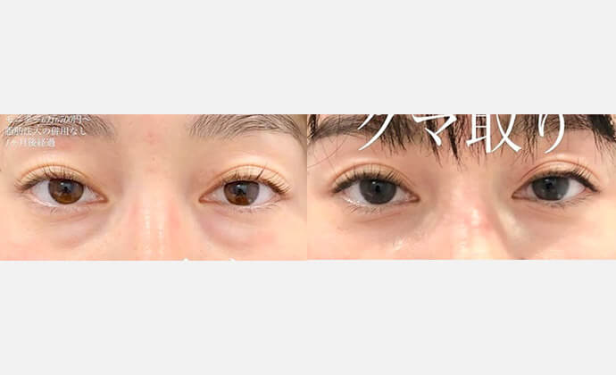 黒クマ・影くまの症例