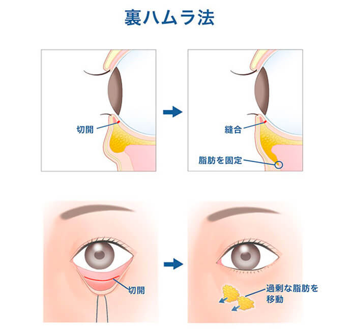 経結膜ハムラ法の施術