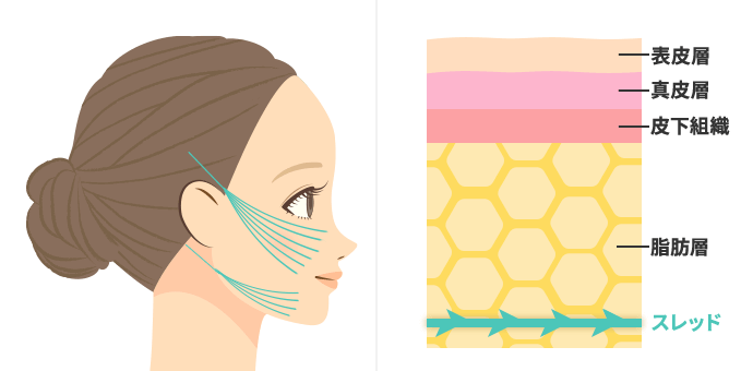 糸リフトの仕組み