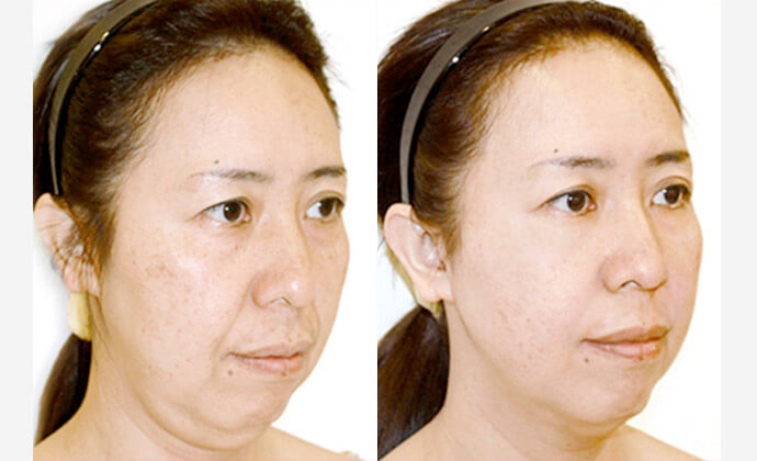 糸リフトの症例