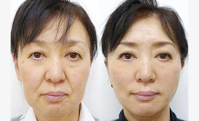 糸リフトの症例