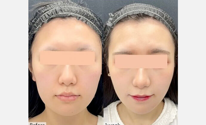 糸リフトの症例