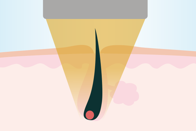 医療レーザー脱毛とは