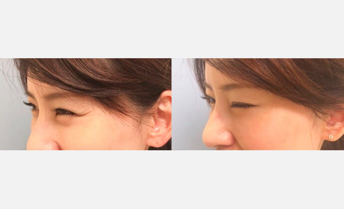 ボトックス（ボツリヌス菌注射）の症例