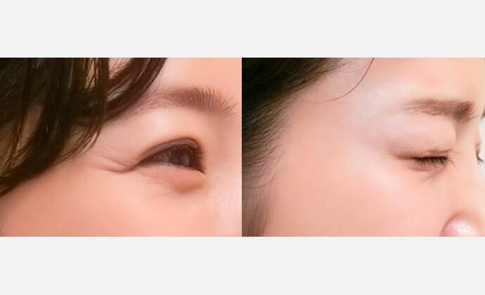 ボトックス（ボツリヌス菌注射）の症例