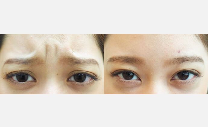 ボトックス（ボツリヌス菌注射）の症例