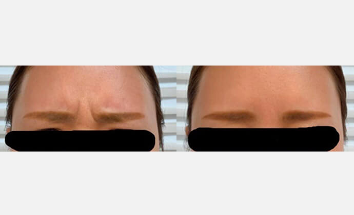 ボトックス（ボツリヌス菌注射）の症例