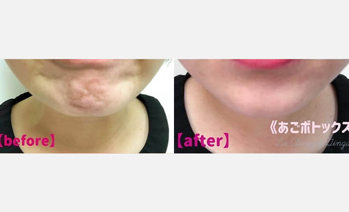 ボトックス（ボツリヌス菌注射）の症例