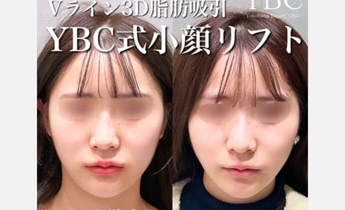 糸リフトの症例