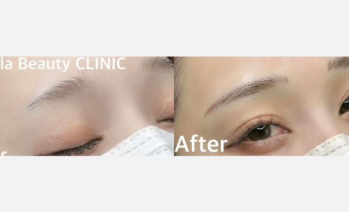 アートメイクの症例