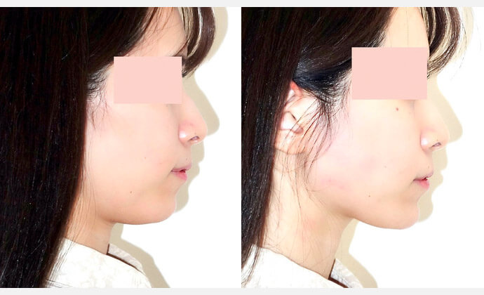 糸リフトの症例