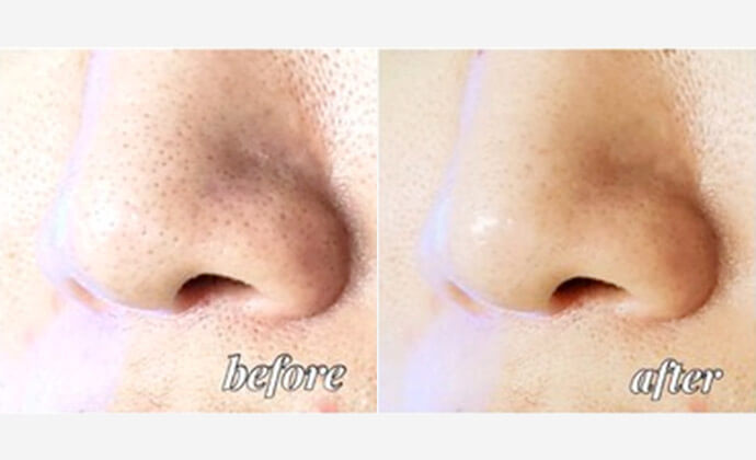 ハイドロピーリングの症例