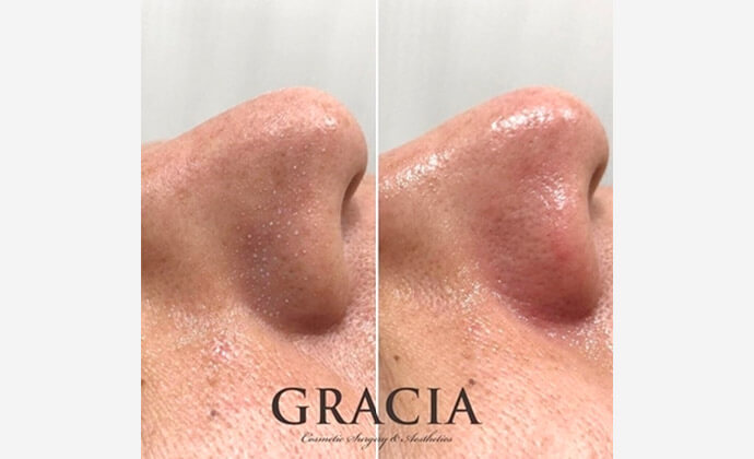 ハイドロピーリングの症例