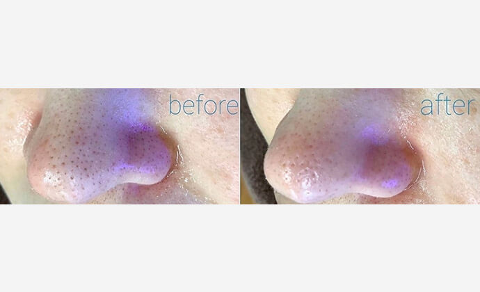 ハイドロピーリングの症例