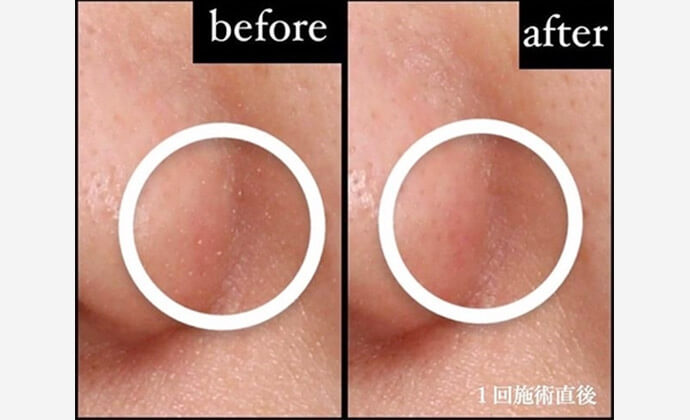 ハイドロピーリングの症例