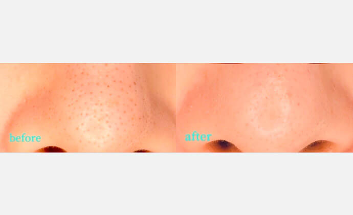 ハイドロピーリングの症例