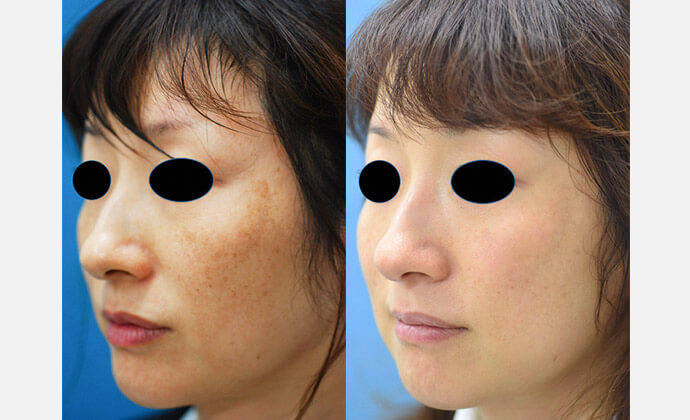 レーザートーニング照射の症例