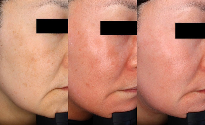 ゼオスキンセラピューティックの症例