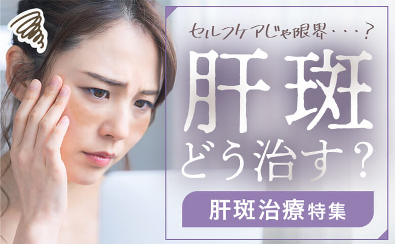 肝斑どう治す？ 治療法とおすすめクリニック＆プラン特集