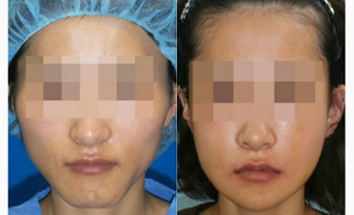 アゴ骨削り（オトガイ形成）の症例