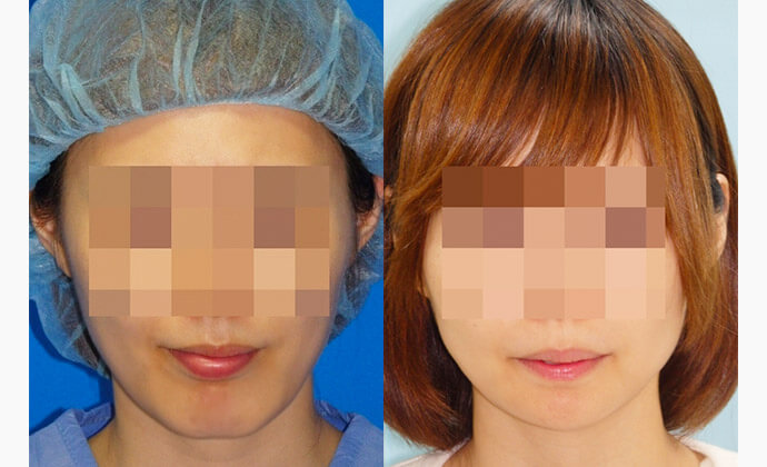 アゴ骨削り（オトガイ形成）の症例