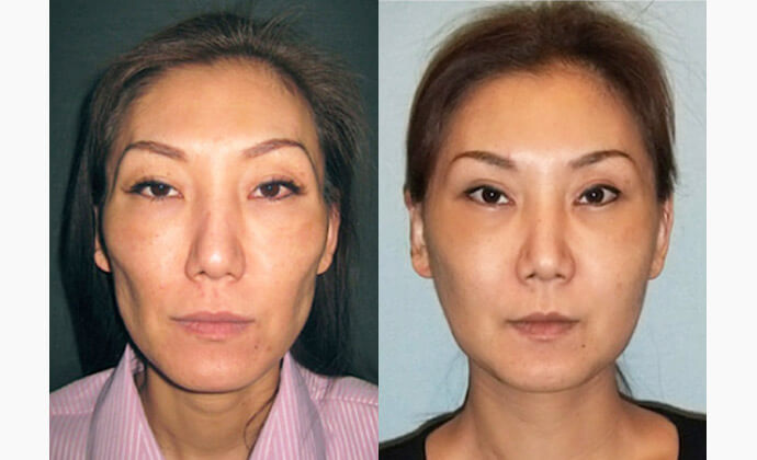 ホホ骨削り（頬骨形成）の症例