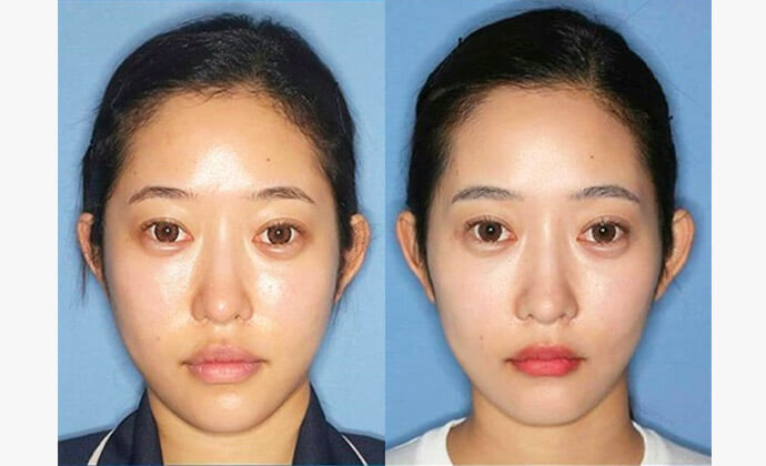 中顔面短縮（ルフォー/上顎短縮）の症例