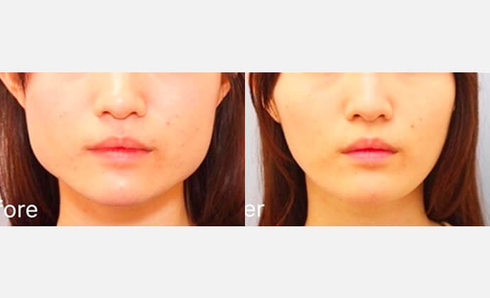 エラ削り（下顎角形成）の症例