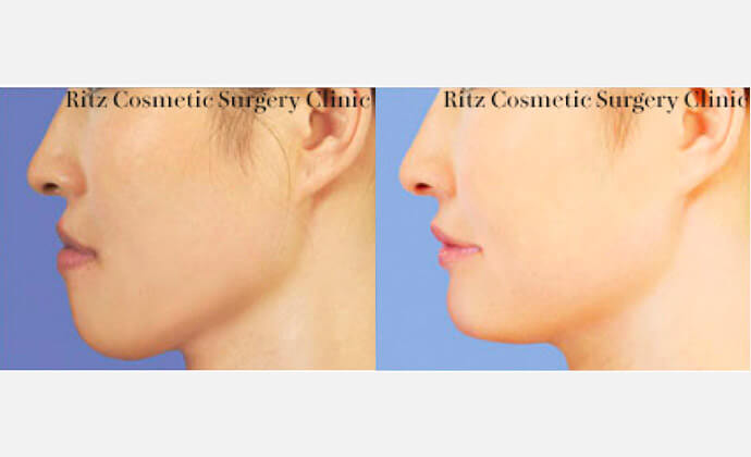 下顎前突症・上顎前突症の症例