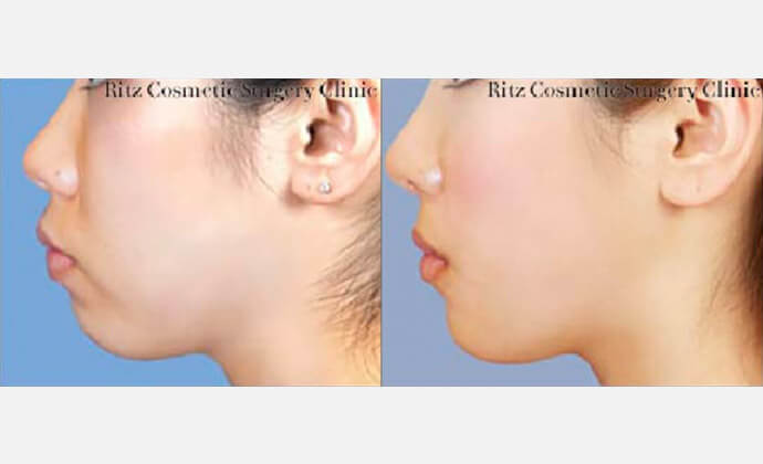 下顎前突症・上顎前突症の症例