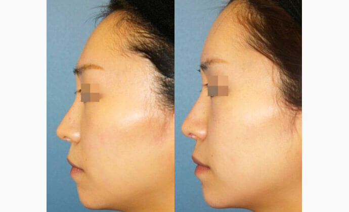 前額形成の症例