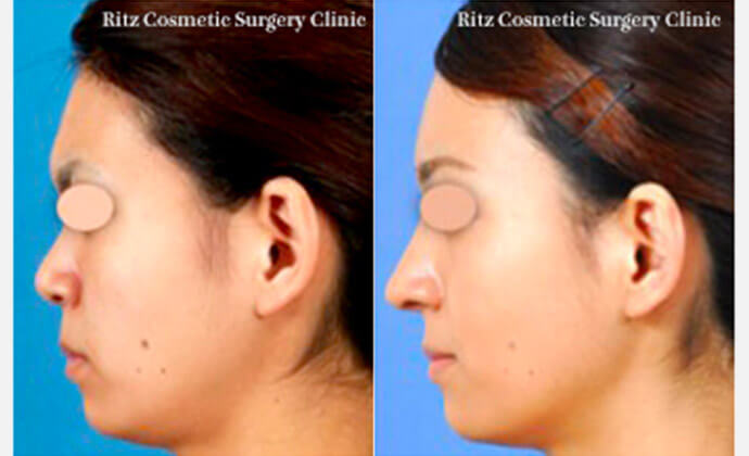 前額形成の症例