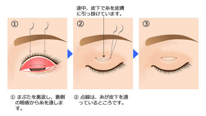 ループ式埋没法
