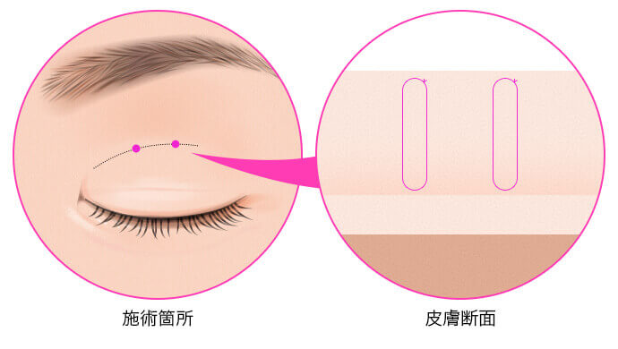 点留めの埋没法