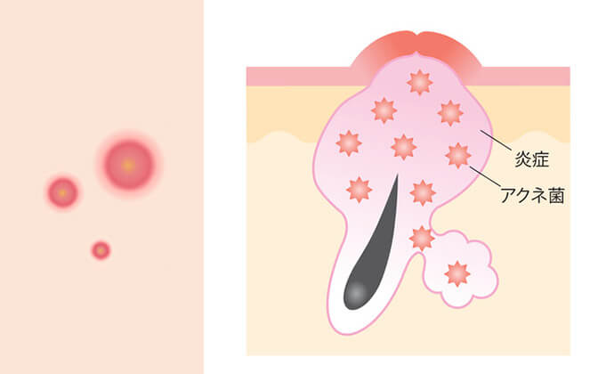 赤ニキビ